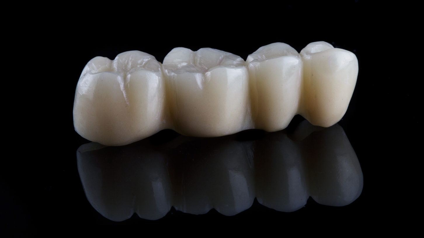 Dental Bridges in Windsor