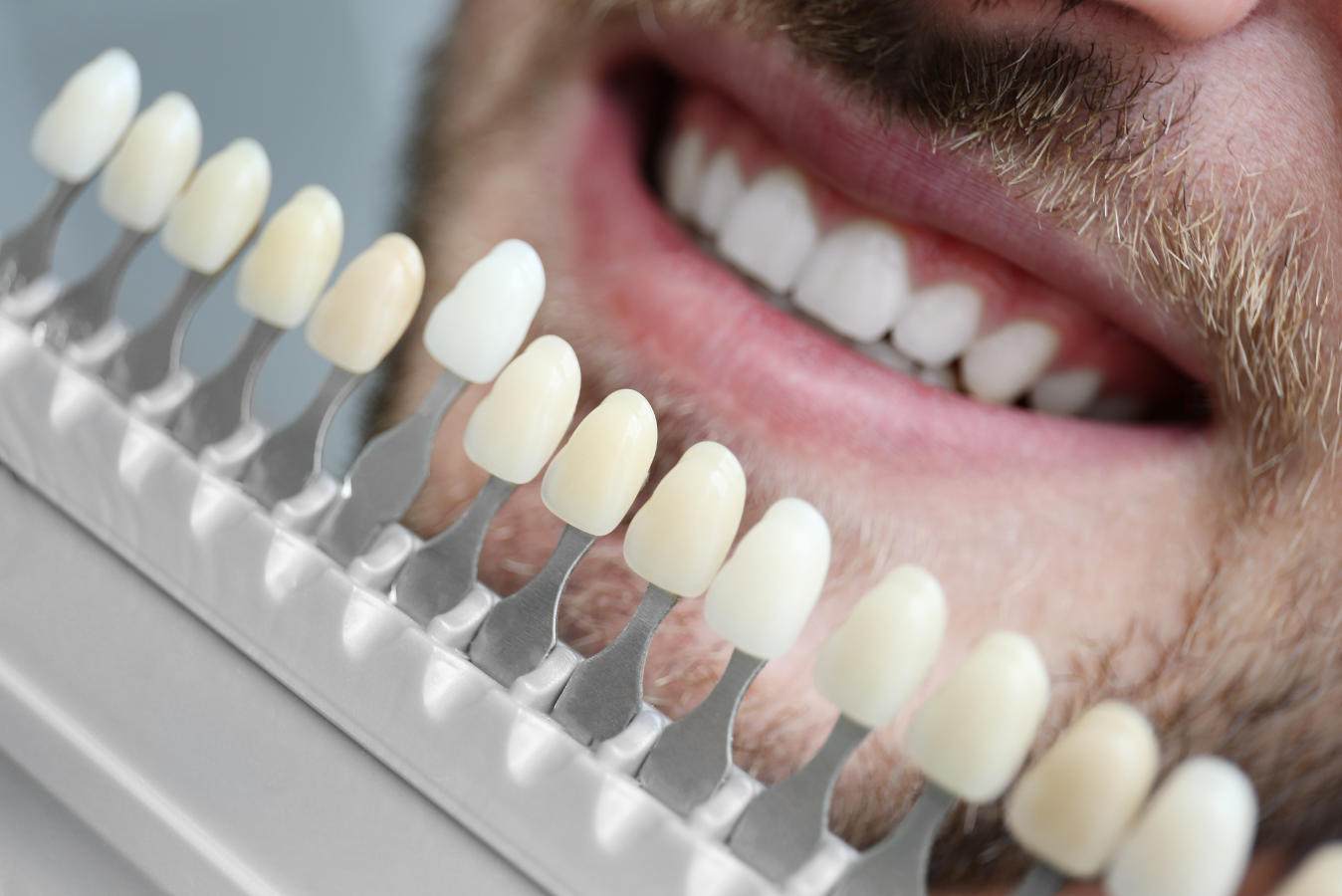 Dental Veneers in Windsor