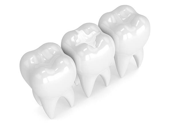 white fillings in Hamilton