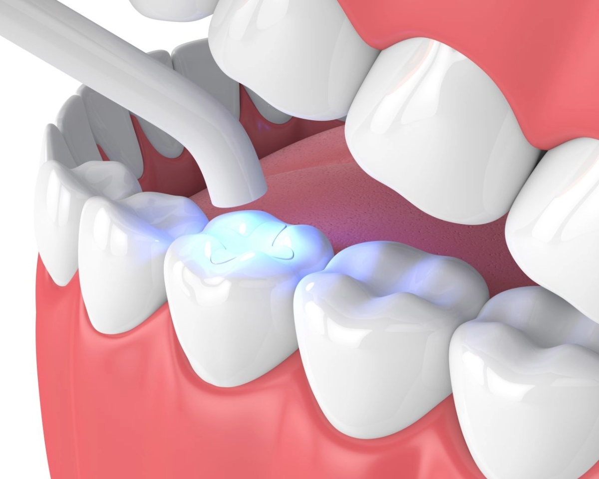 what are white fillings are white fillings as durable