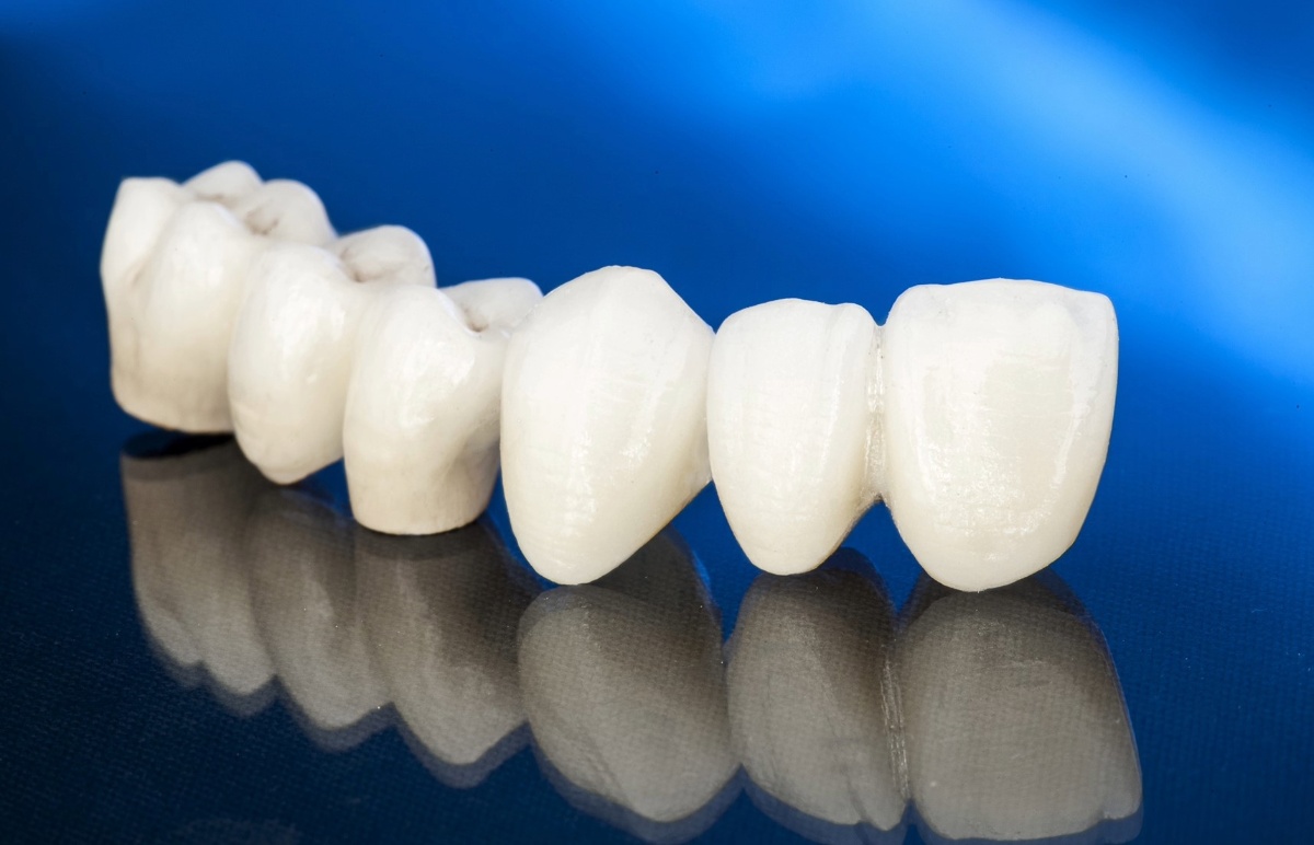 how long do dental crowns and bridges last, and how do i maintain