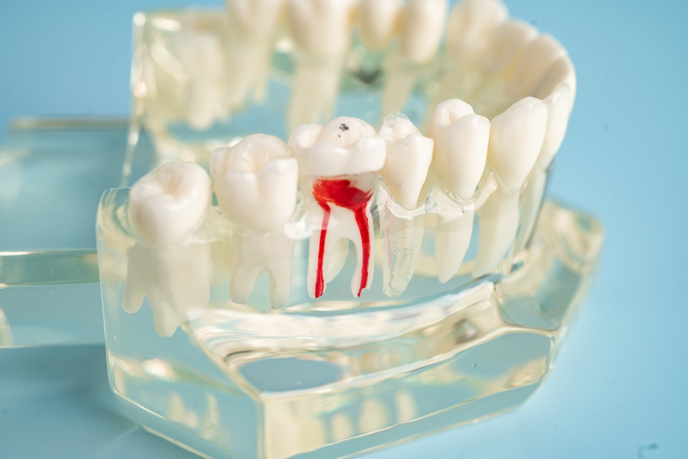 cost of root canal treatment covered under a canadian dental care plan