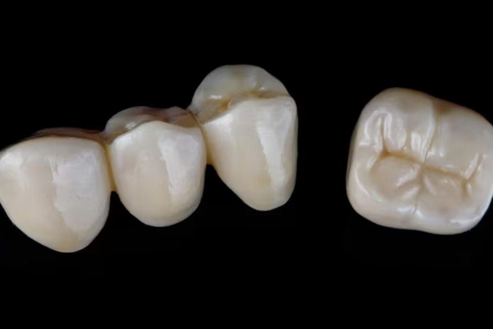 What is a Dental Crown? When is it needed? And what is its Cost?