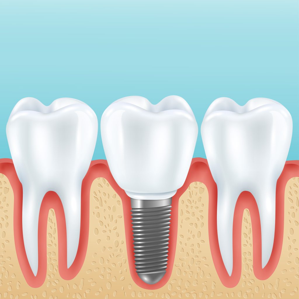 Which is Better, Dentures or Dental Implants?