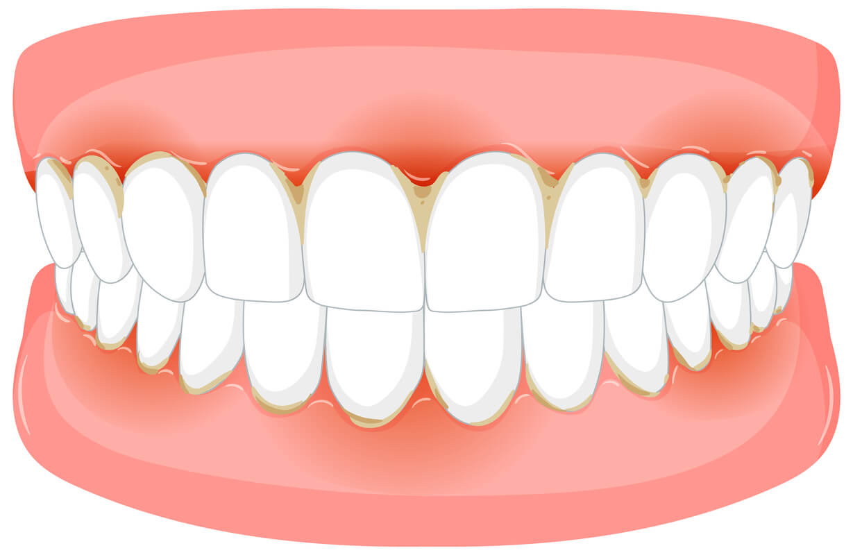 is it better to get full dentures or partials