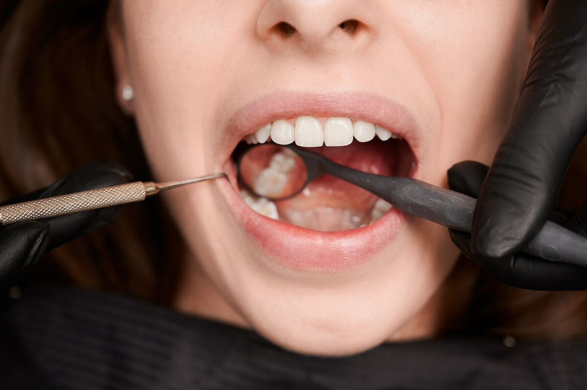 when did white dental fillings become popular