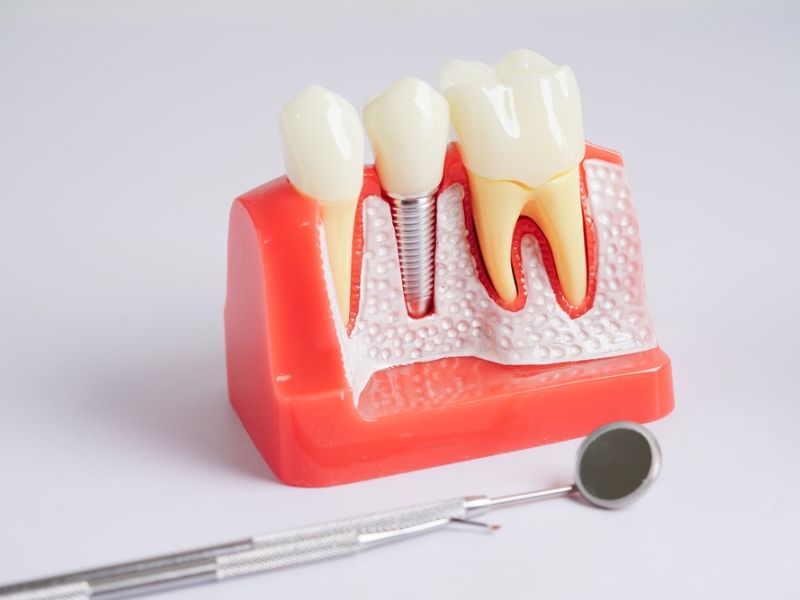 dental implants explained procedure, benefits, and aftercare