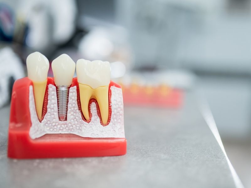 what happens before, during, and after dental implant surgery